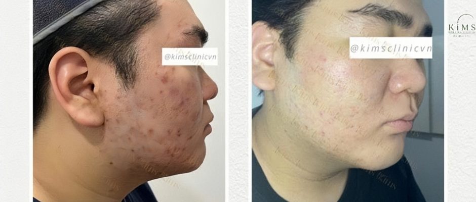 Làn da được cải thiện sau một liệu trình chăm sóc da mặt chuyên sâu tại Kims