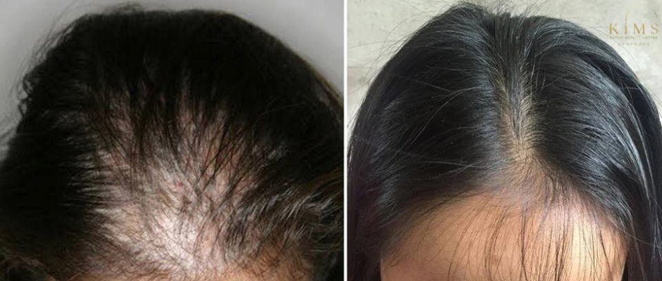 Tiêm rụng tóc bằng phương pháp Meso đã được chứng minh mang lại hiệu quả rõ rệt
