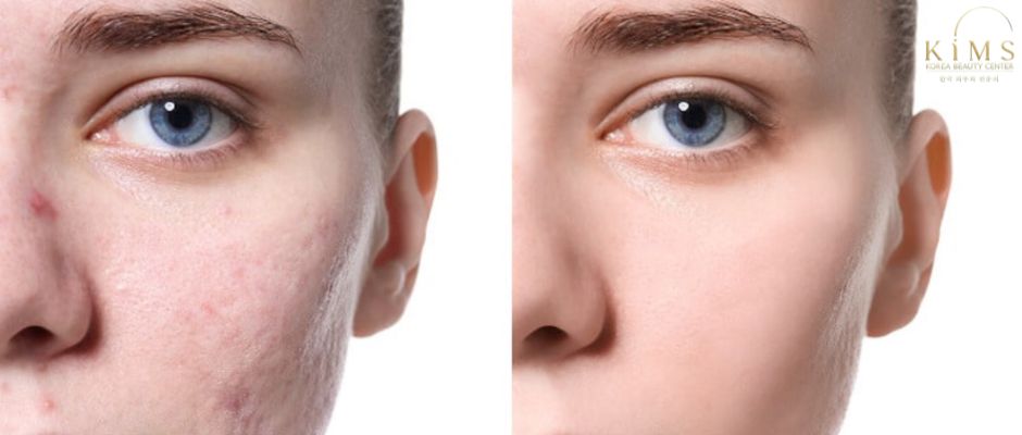 Trị sẹo bằng các phương pháp tiêm PRP, tiêm Meso,...