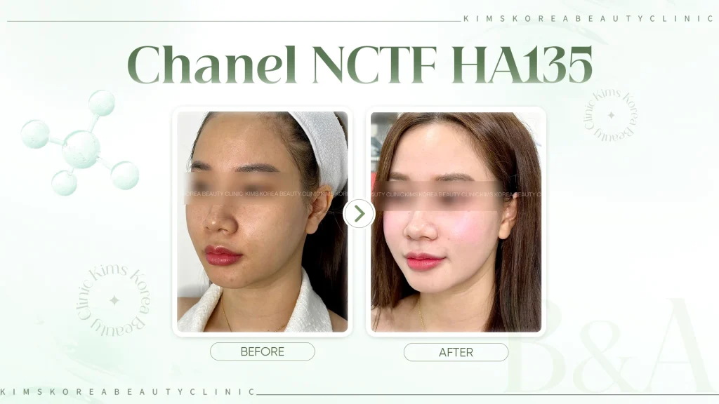 hình before after khi tiêm meso Chanel NCTF HA135