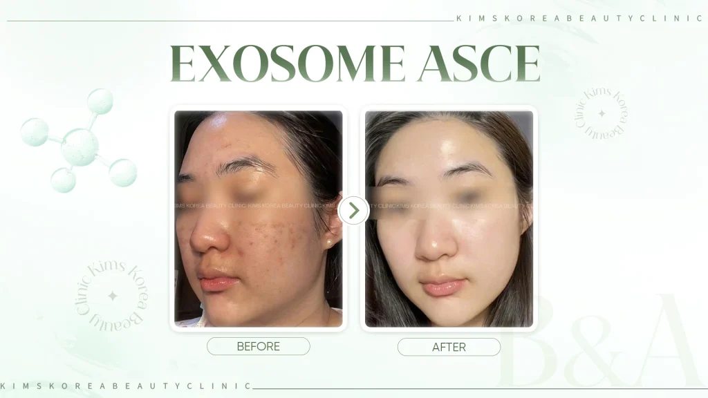 Hình before - after Exosome ASCE