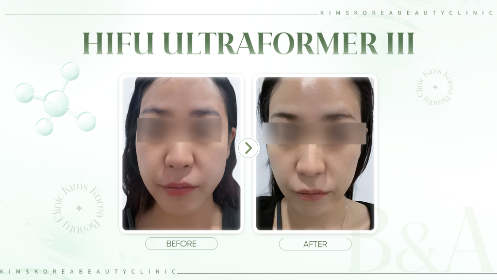 HINH-2---HIFU-ULTRAFOMER-III