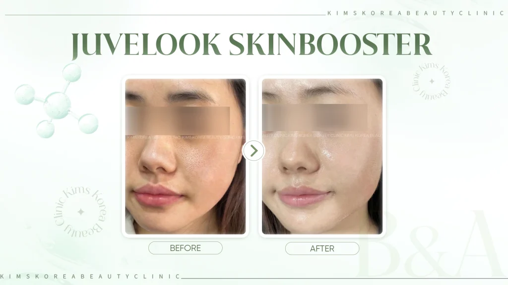 hình before - after Juvelook Skinbooster
