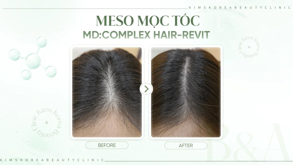 hình ảnh before after tiêm mọc tóc