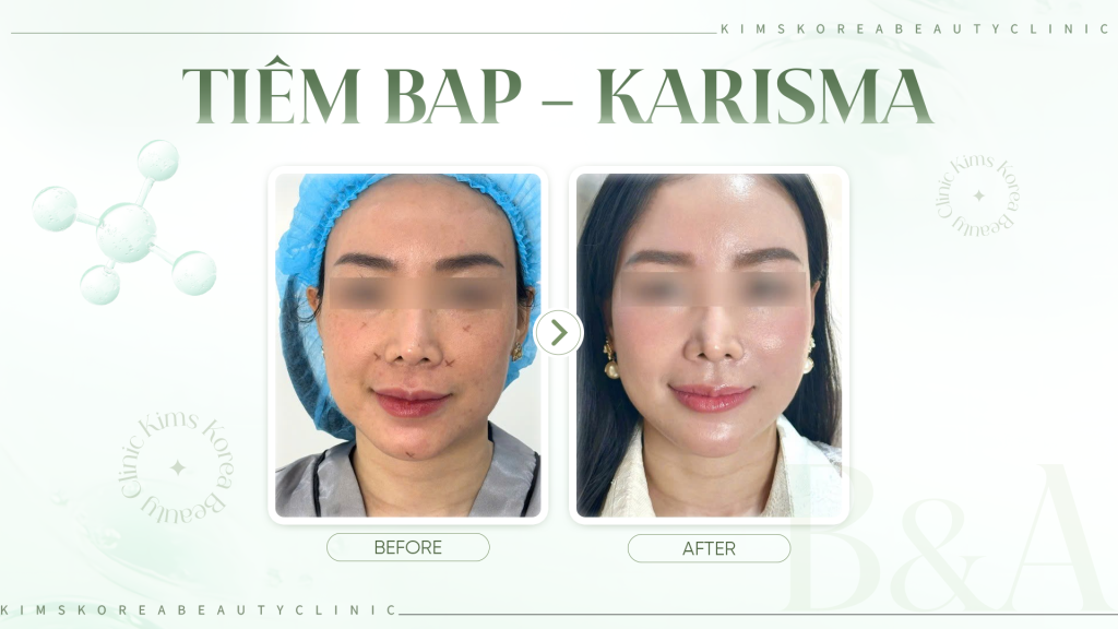 HINH-2---Tiêm-BAP---Karisma