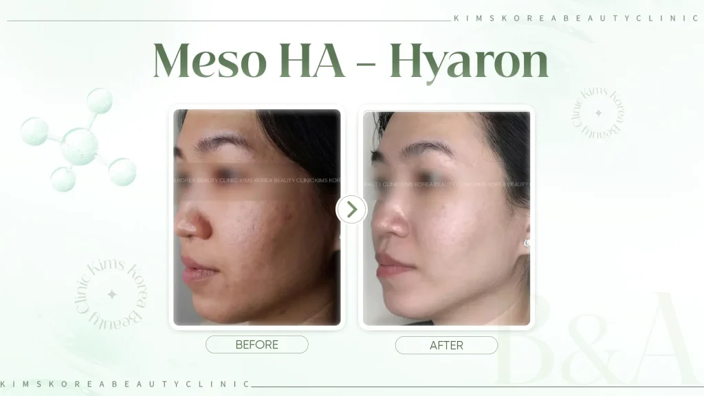 hình before after tiêm meso HA