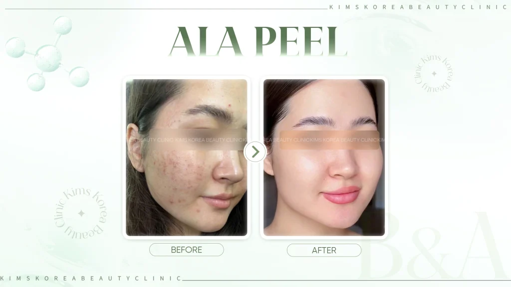 alapeel-hinh-2