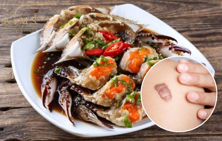 Ăn cua có bị sẹo lồi không?