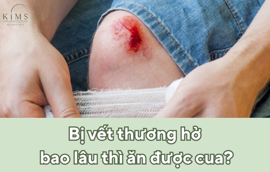 Hướng dẫn chăm sóc vết thương hở để tránh bị sẹo lồi