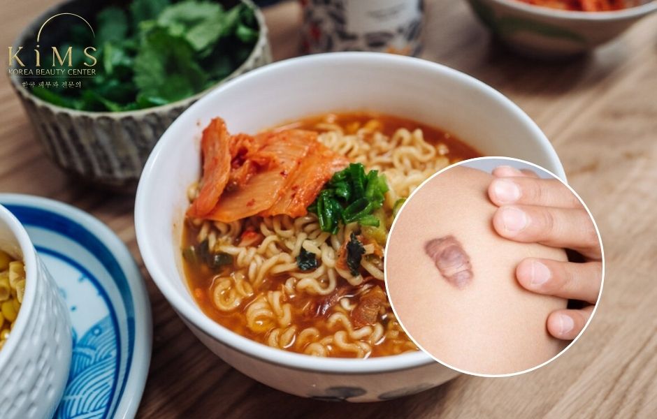 ăn mì tôm có bị sẹo lồi không