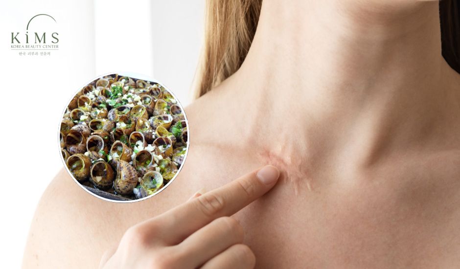 Ăn ốc có bị sẹo lồi không