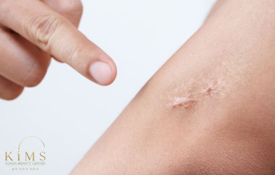 Ăn thịt bò có bị sẹo lồi không?