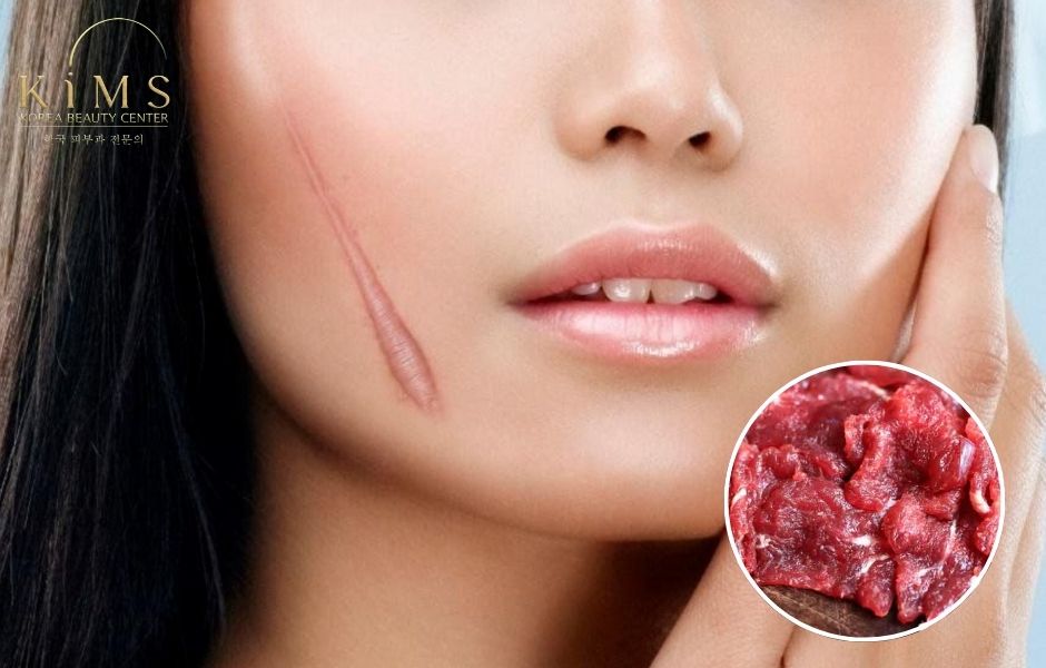 Ăn thịt bò có bị sẹo lồi không