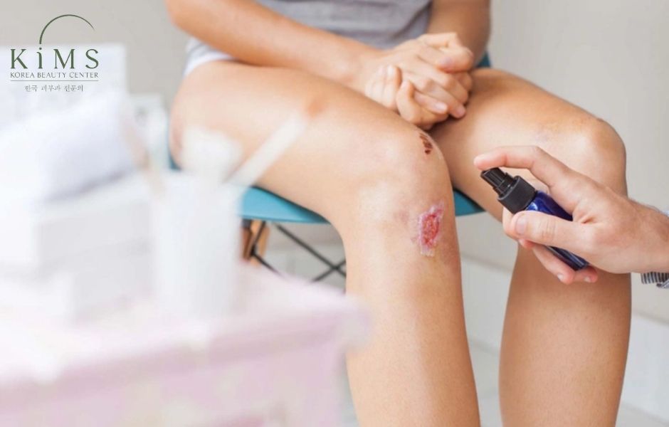Hướng dẫn chăm sóc vết thương hở để tránh sẹo lồi