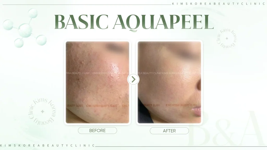 hình ảnh Before - After Basic Aquapeel