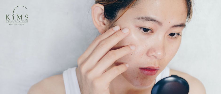Một số phương pháp làm giảm mụn ở tuổi dậy thì