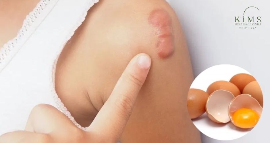 Chỉ ăn trứng khi vết thương đã ổn định.