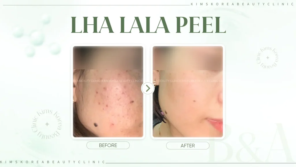 lha-lala-peel-hinh-2