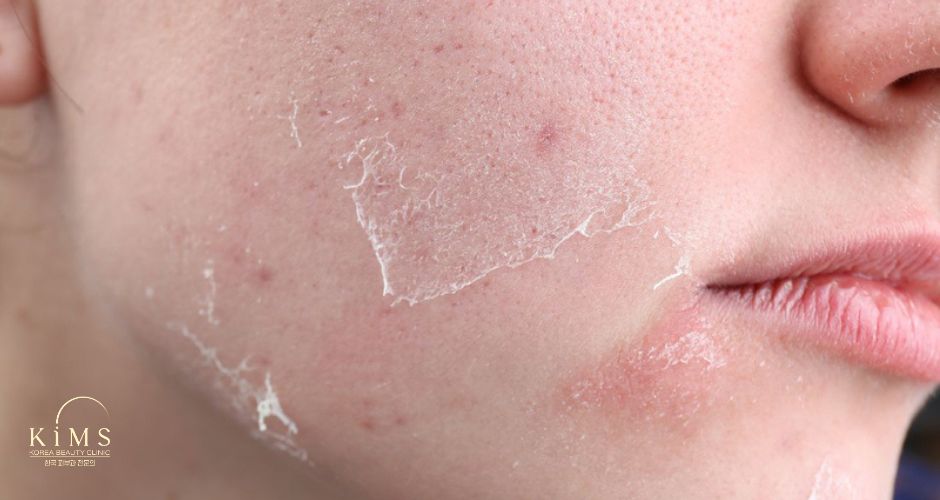 Một số lưu ý trước khi peel để mang lại hiệu quả trên làn da.