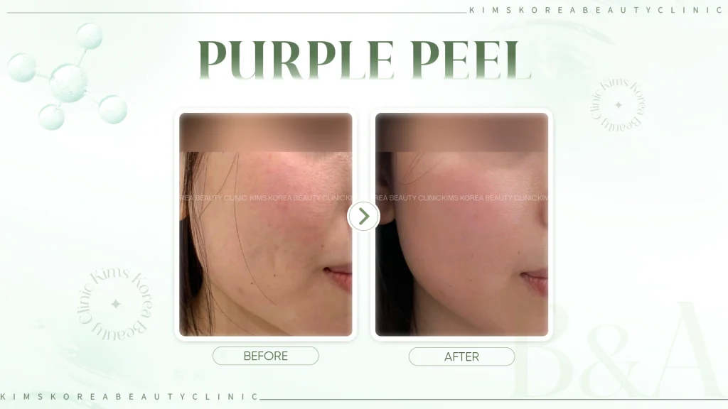 purple-peel-hinh-2