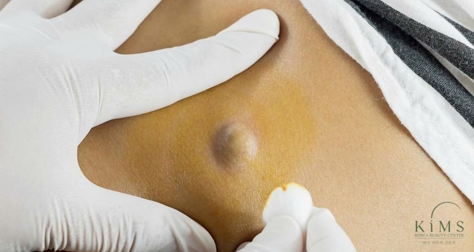 Quy trình khử trùng đảm bảo vô trùng trước khi thực hiện.