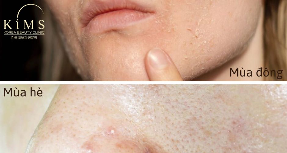 Sự thay đổi của da hỗn hợp theo mùa.