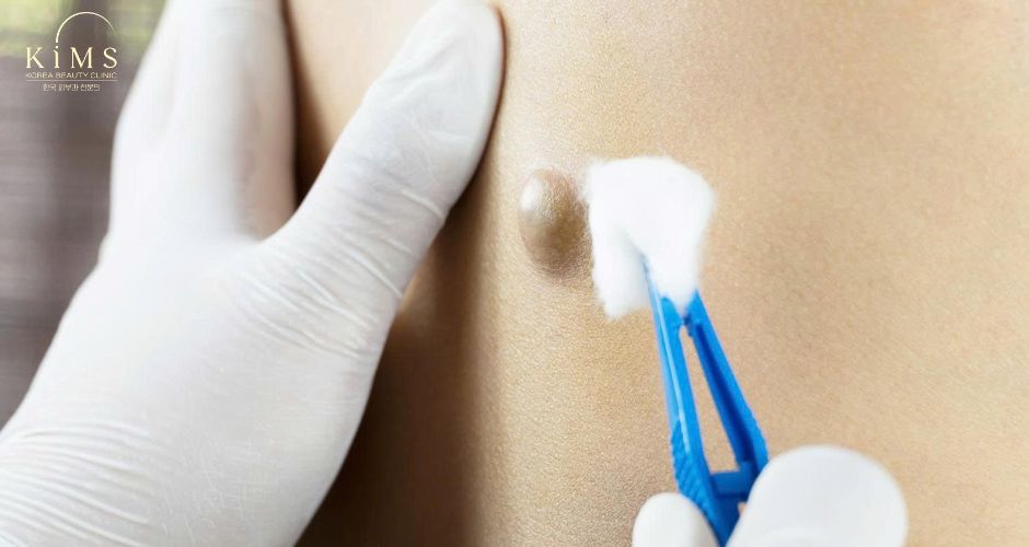 Thăm khám trước khi thực hiện tiểu phẫu u bã đậu.