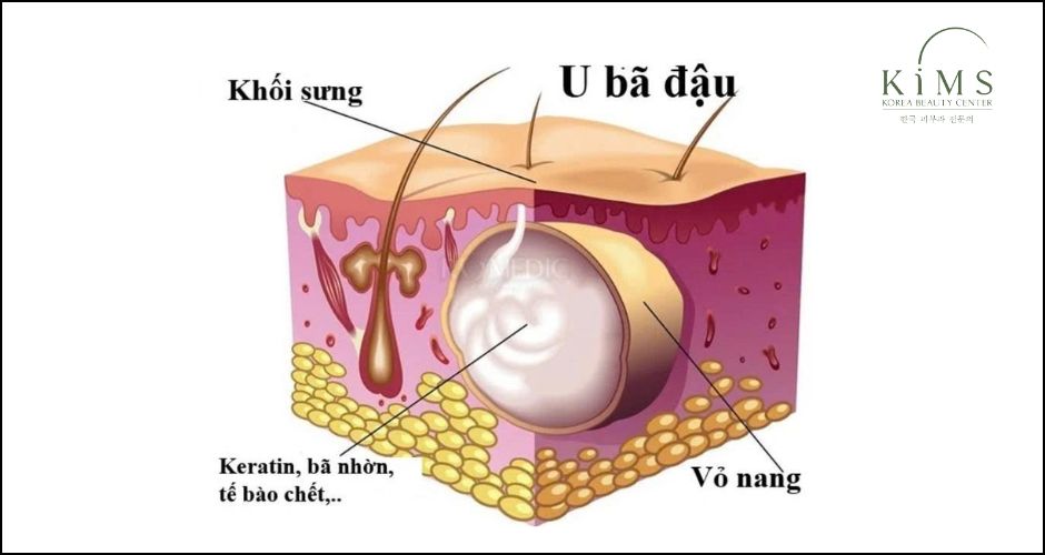 Cấu tạo của u bã đậu