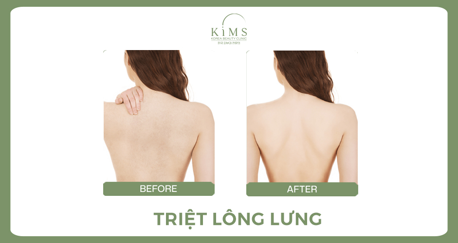 triet-long-lung-hinh-before-after