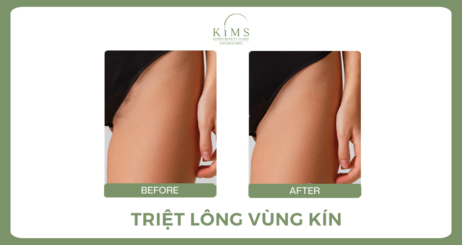 triệt lông vùng kín