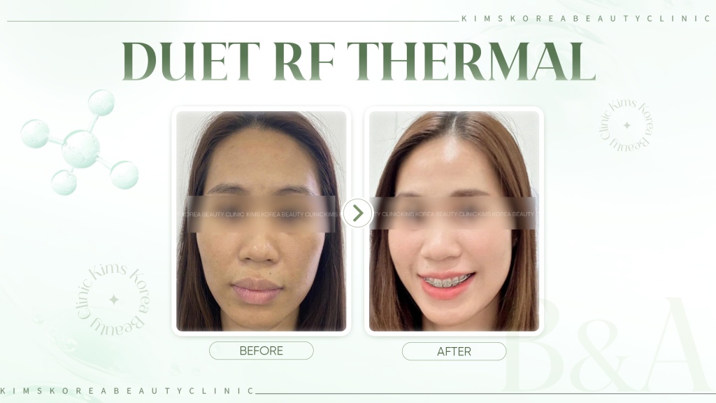 HINH-2---Duet-RF-Thermal