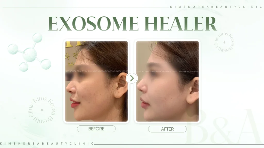 hình before after Exosome Healer