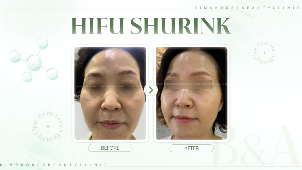 HINH-2---HIFU-SHURINK