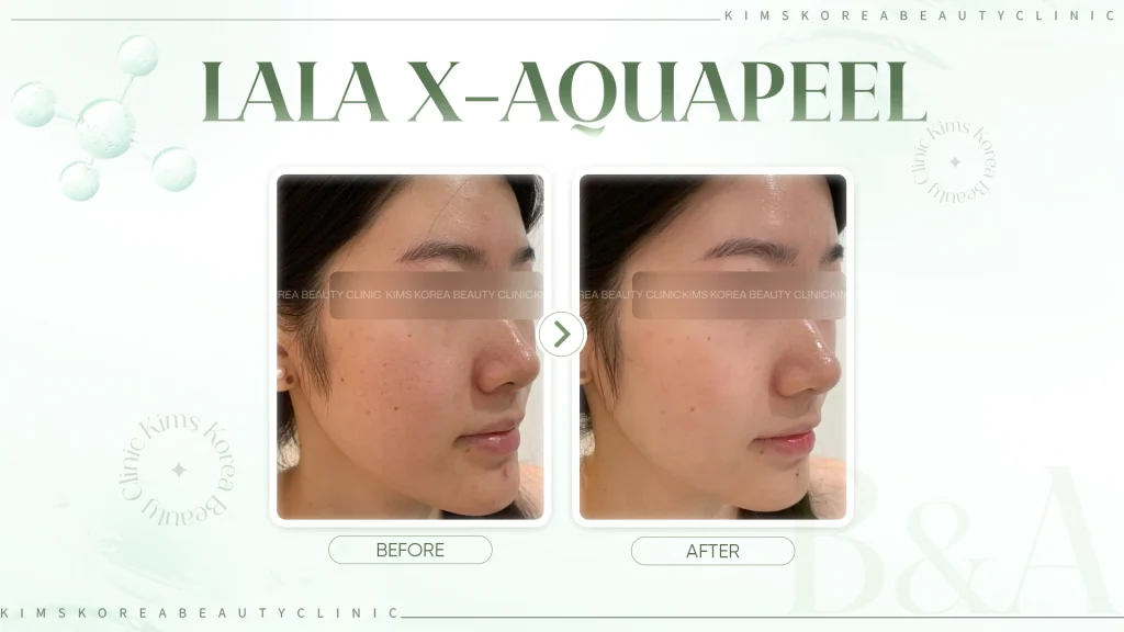 HINH-2-Lala-X