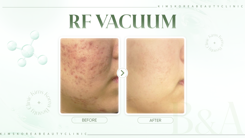 HINH-2---RF-Vacuum