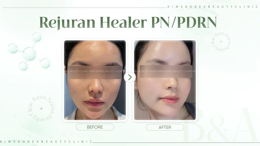 hình before after Rejuran Healer PN/PDRN