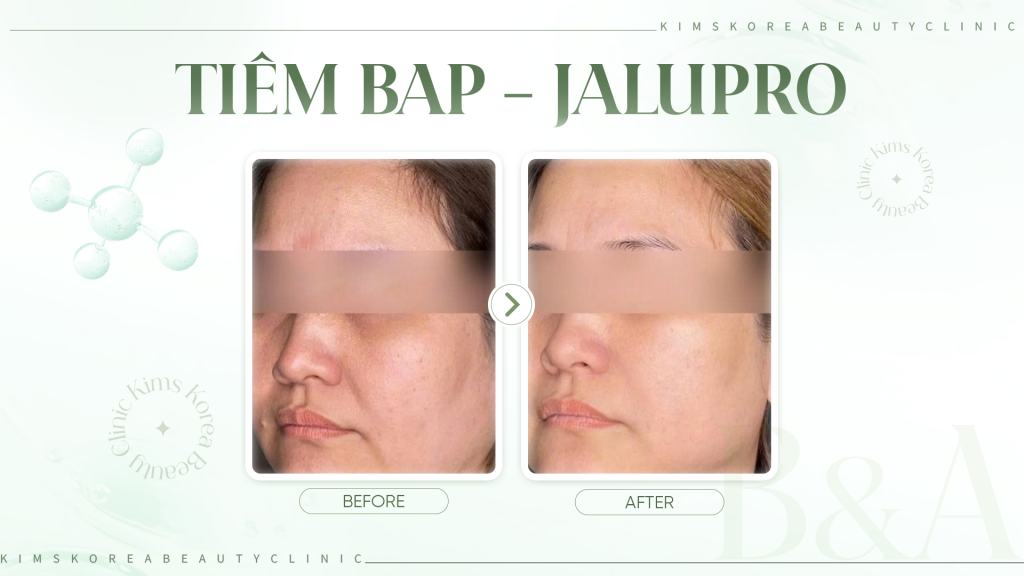HINH-2---Tiêm-BAP---Jalupro