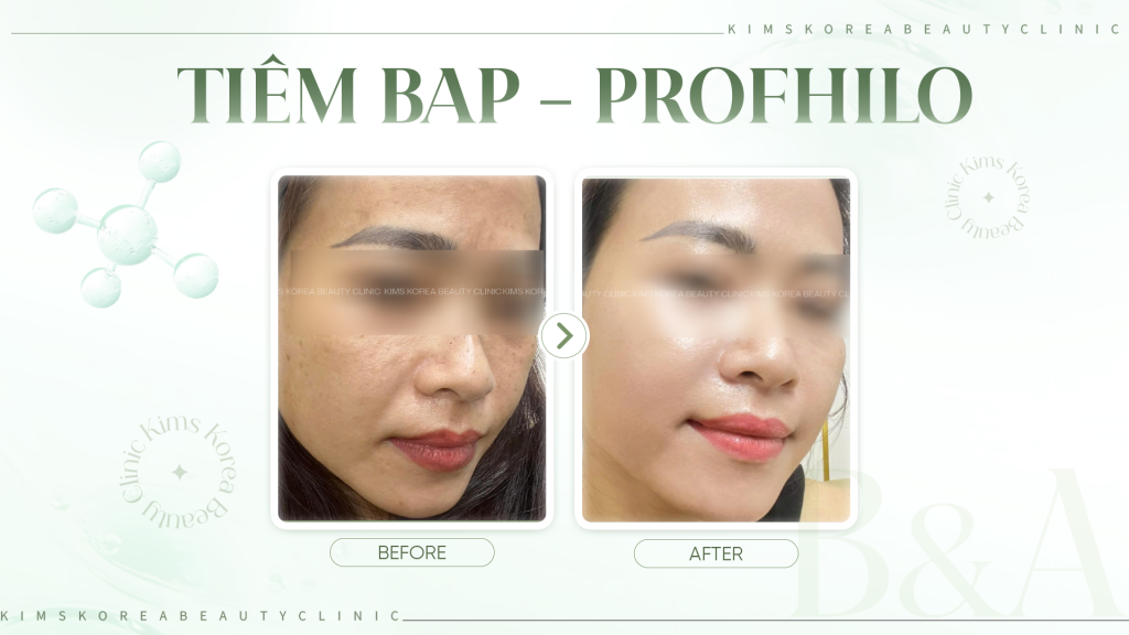 HINH-2---Tiêm-BAP---Profhilo