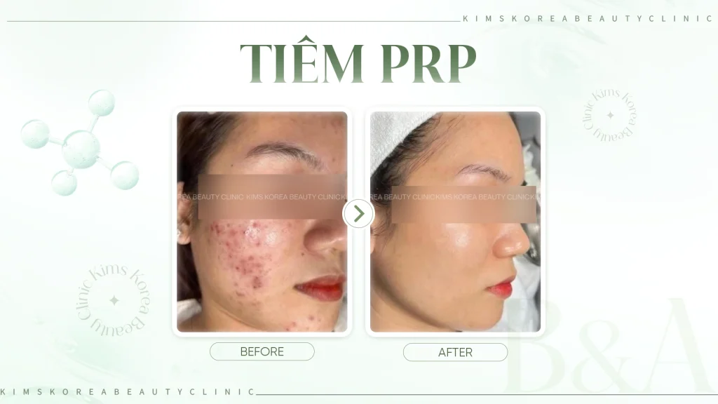 liệu trình tiêm PRP kéo dài 50 phút
