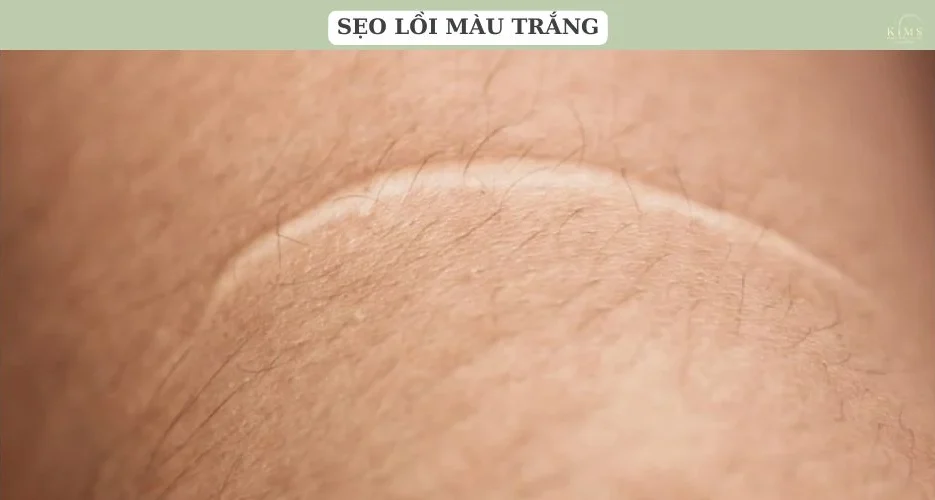Sẹo trắng hình thành do mất sắc tố da.