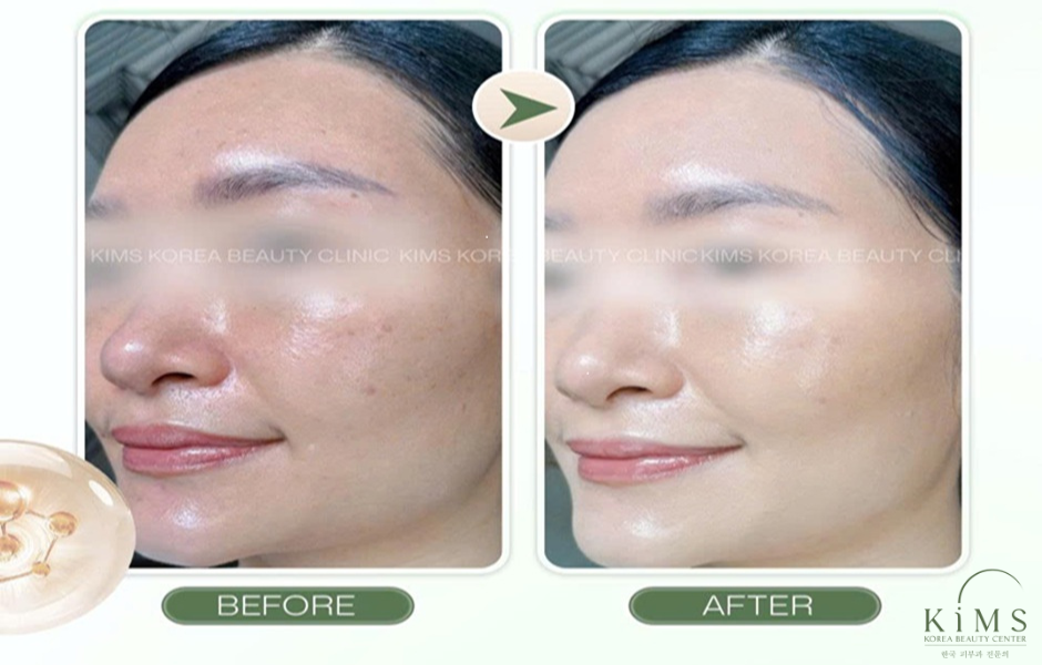 Trước và sau khi thực hiện Shiseido Aquapeel.