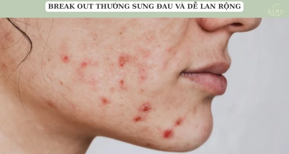 Break out thường sưng đau và dễ lan rộng.