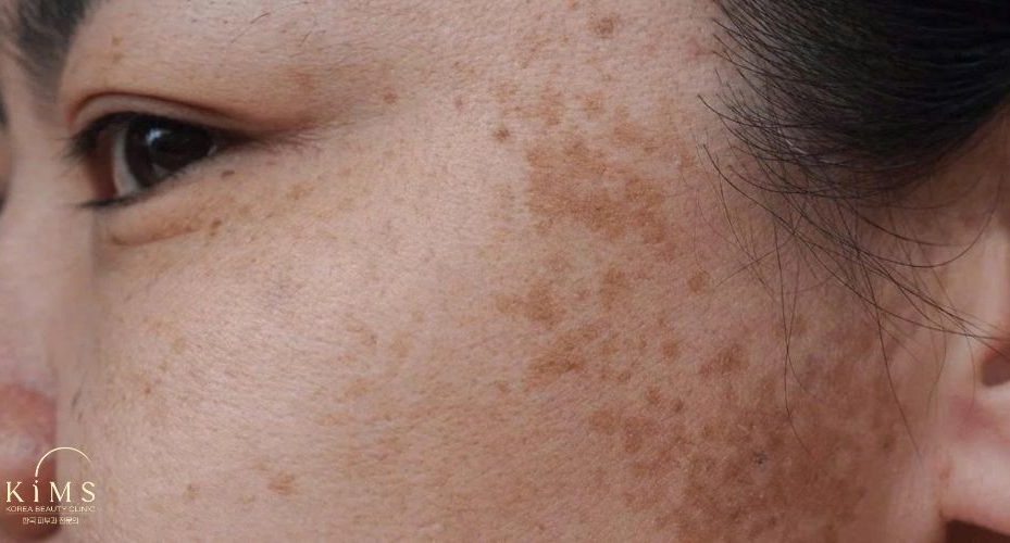 Tuỳ mức độ nám và phương pháp điều trị. Có thể từ 2–6 tháng hoặc lâu hơn.