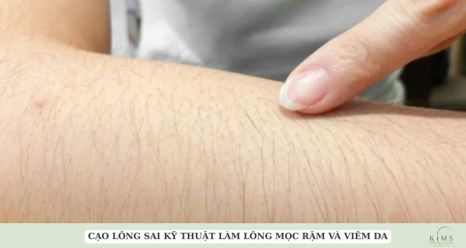 Viêm nang lông và lông mọc nhiều hơn sau cạo.