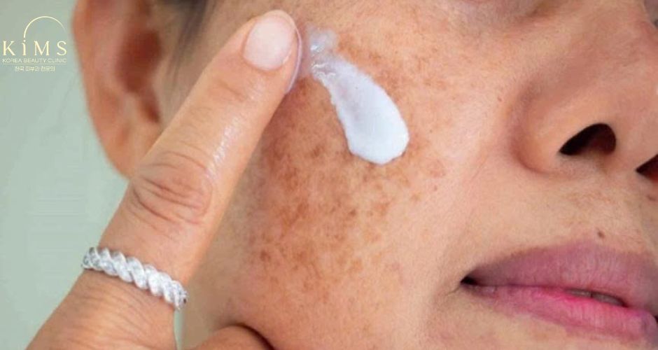 Kết hợp kem chống nắng để bảo vệ da sau điều trị và phòng ngừa nám.