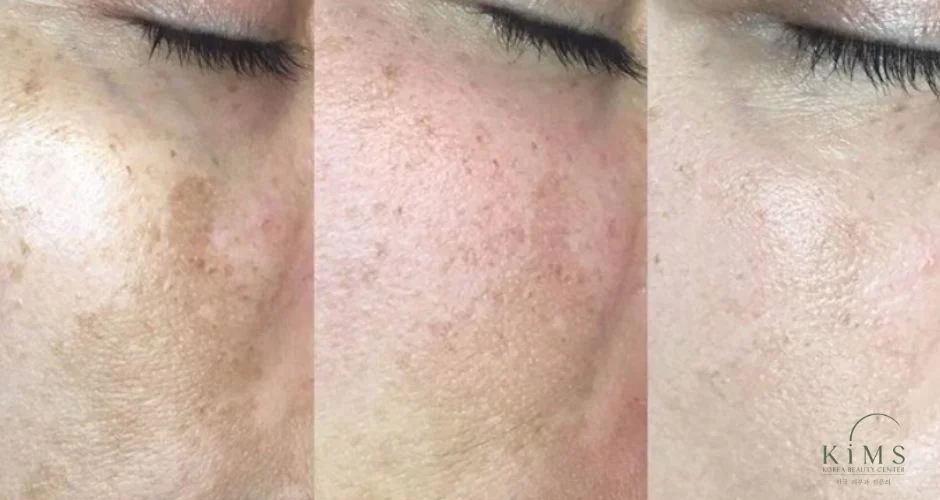 Cải thiện da nám bằng sữa chua lâu hơn điều trị.