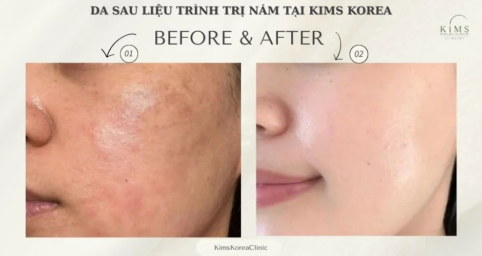 Da sau điều trị nám tại Kims.