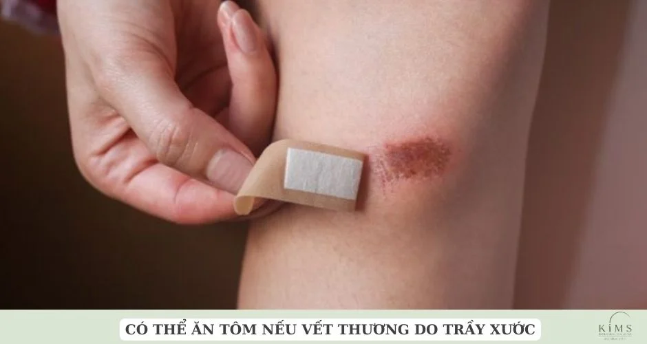 Có thể ăn tôm khi vết thương lành hẳn.