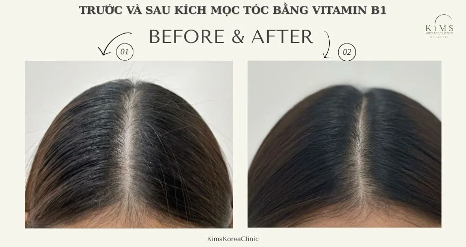 Trước và sau kích mọc tóc.