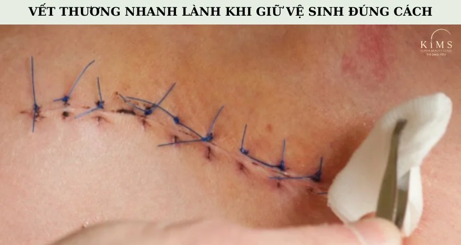 Giữ vết thương sạch sẽ, không tự ý nặn hoặc chạm vào vết mổ.
